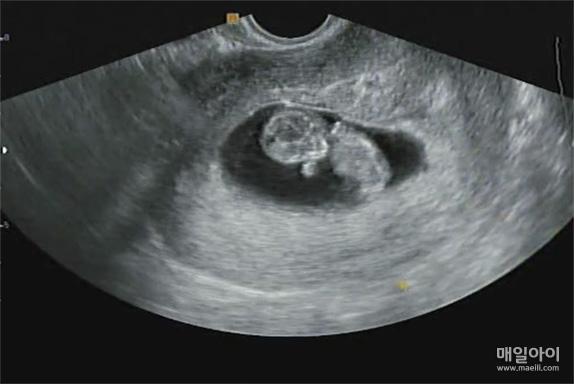 [매일아이] 임신 9주 특징